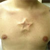 Implants